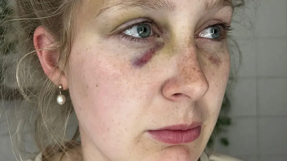 Denise (26) letztes Jahr kurz nach dem brutalen Angriff. Denise (26) letztes Jahr kurz nach dem brutalen Angriff.